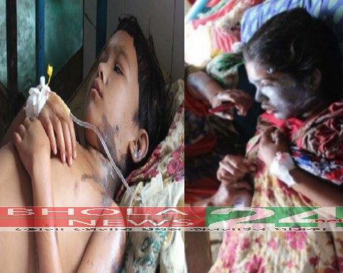 ভোলার উত্তর দিঘলদী ইউনিয়নে রাতের আধাঁরে দুর্বৃত্তের ছোড়া এসিডে দুই বোন দগ্ধ