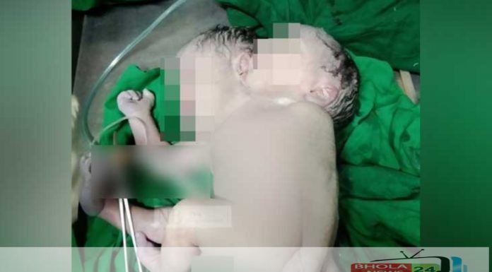 ২ মাথা ৩ পা নিয়ে শিশুর জন্ম, ২ ঘণ্টা পর মৃত্যু